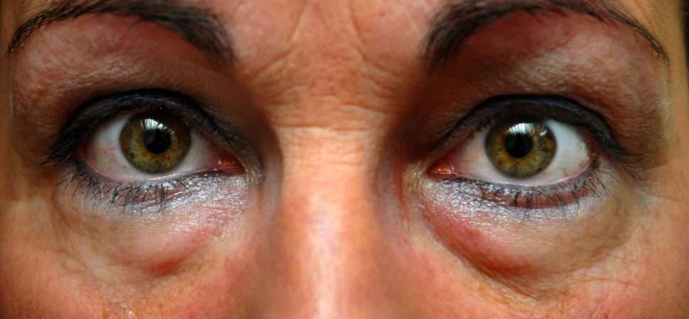 How Allergies Cause Puffy Eyes  How To Get Rid Of Swollen ...