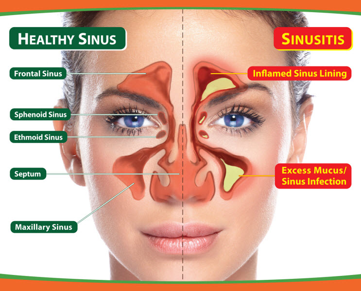 How Chiropractic Care Can Help Relieve Sinus Pressure ...