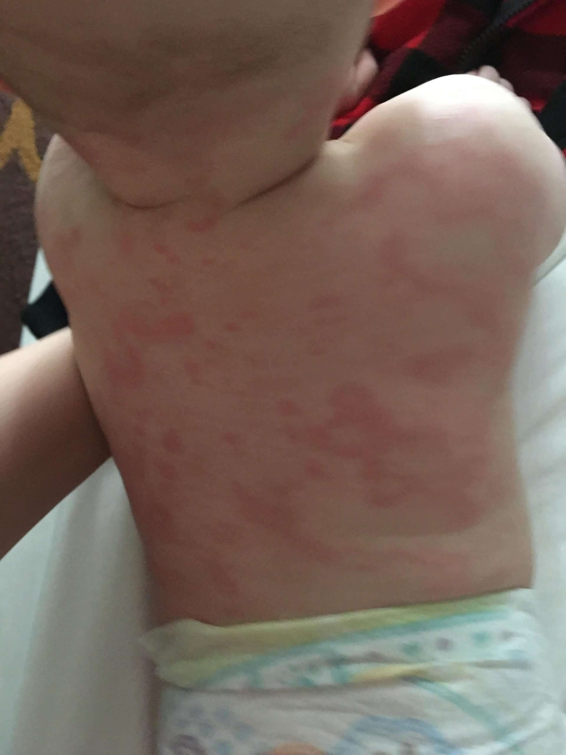 How long do hives last?!? My poor baby is broken out ...