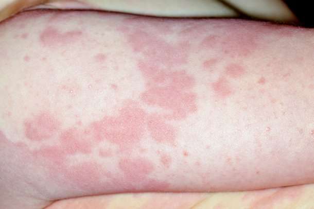How Long Does A Food Allergy Rash Last