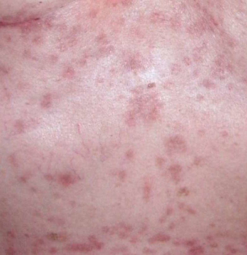 How Long Does Contact Dermatitis Last