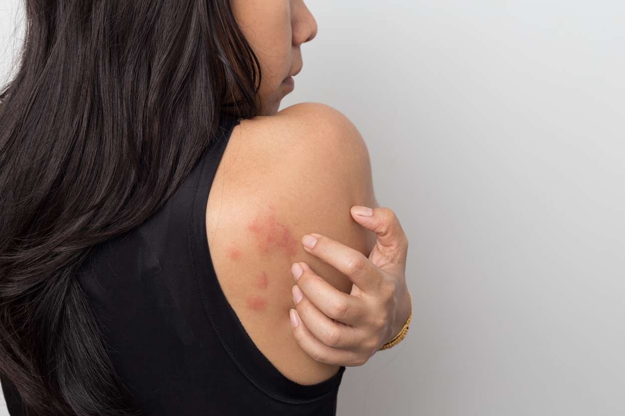 How long does it take for hives to go away?