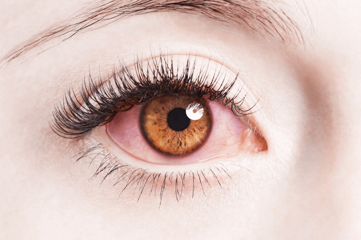 How Long Does Pink Eye Last And How To Fix It