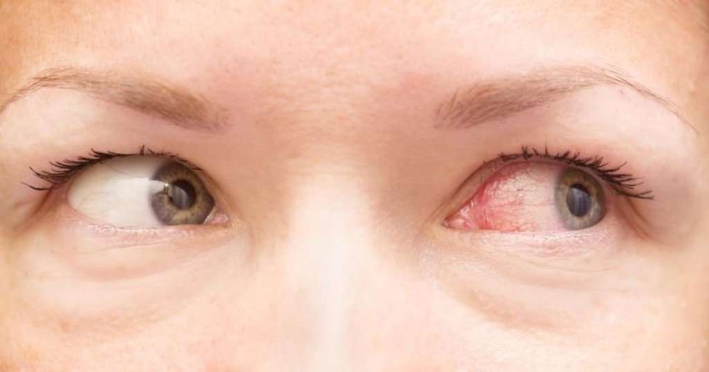 How Long Does Pink Eye Last: Symptoms, Treatment & Prevention