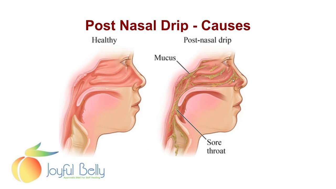 How to cure a post nasal drip sore throat