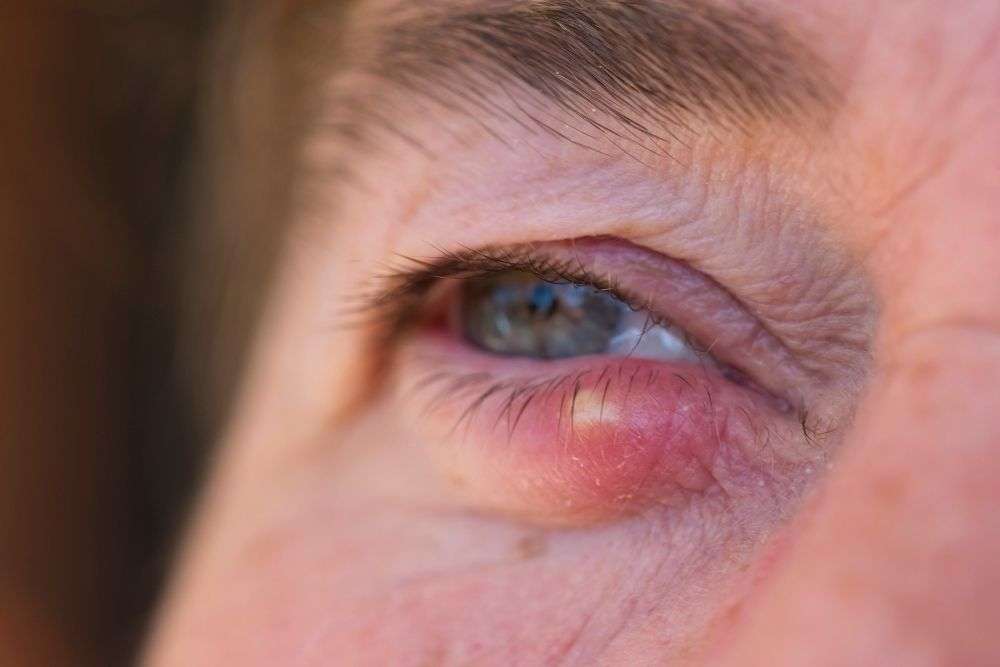 How to Get Rid of a Stye Fast
