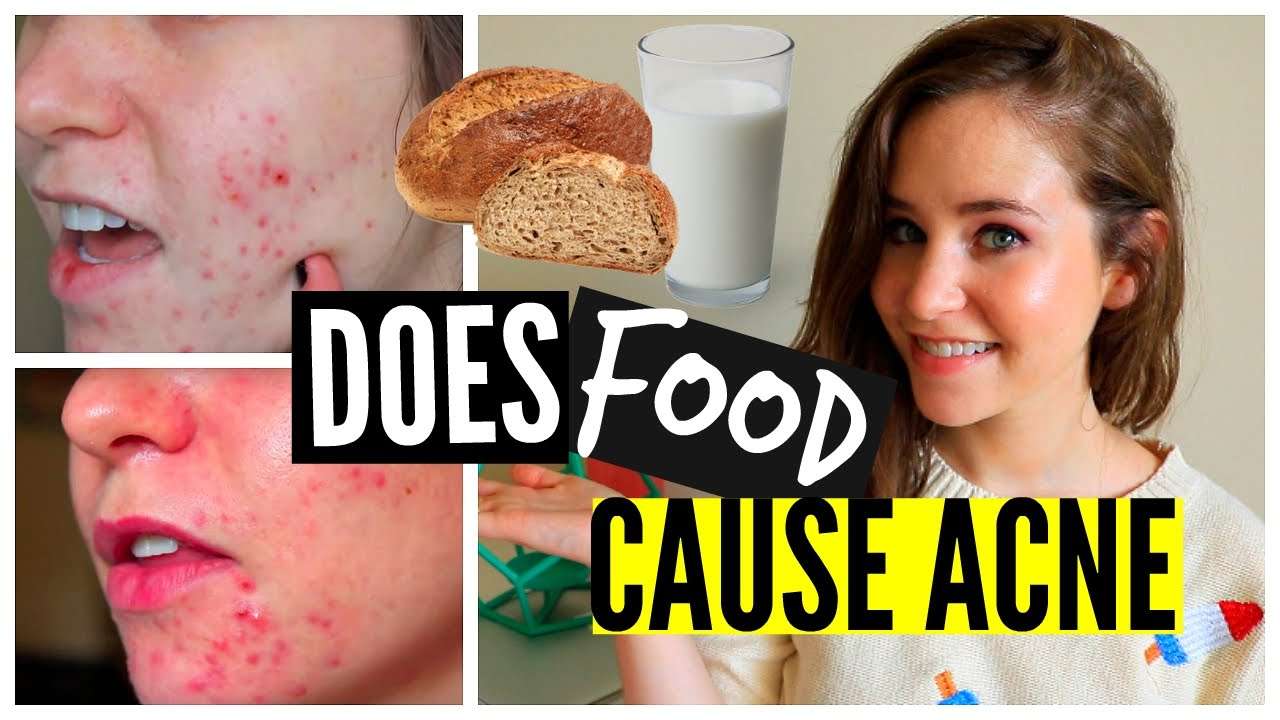 How To Get Rid Of Acne Naturally: Food, Diet, Wheat, Dairy ...