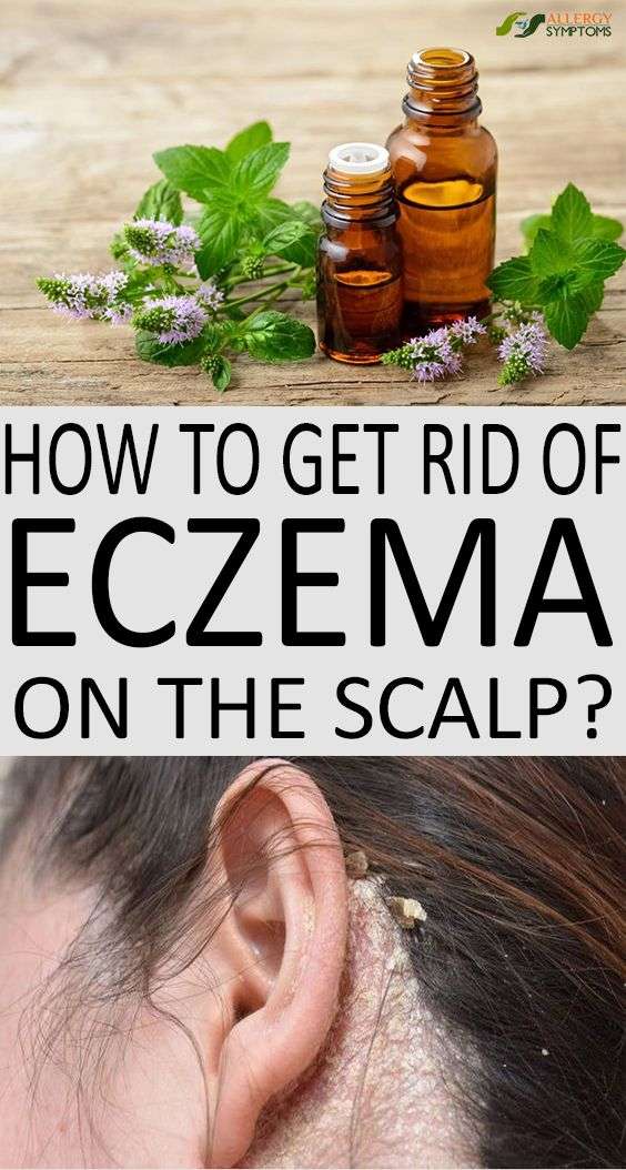 How to Get Rid of Eczema on the Scalp?