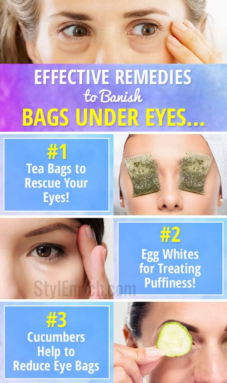 How to Get Rid of Eye Bags : Effective Remedies to Banish ...