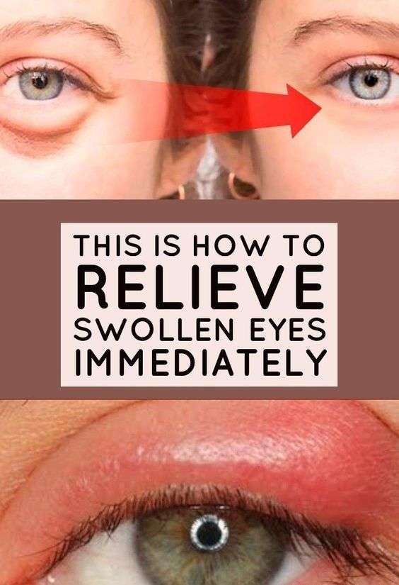 How To Get Rid Of Eye Pimple