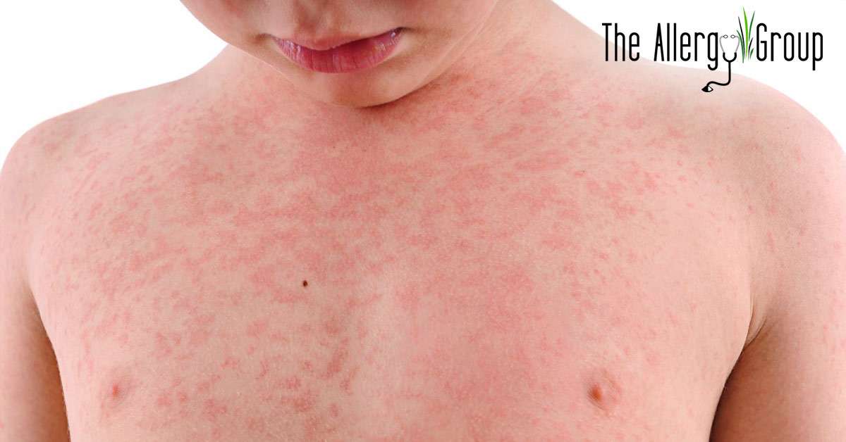How to Get Rid of Hives by Yourself