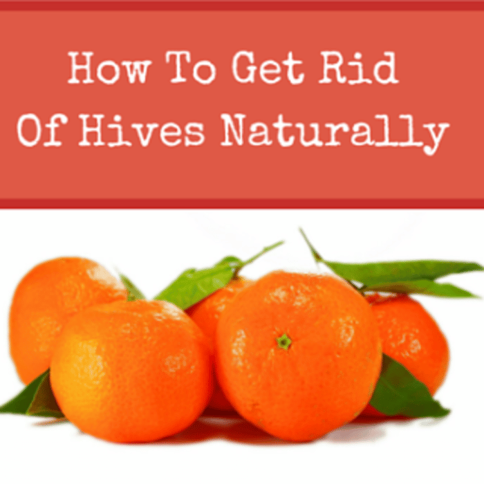 How To Get Rid Of Hives Naturally