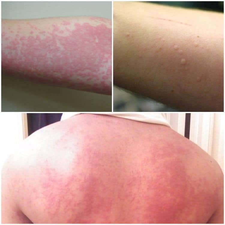 How to Get Rid of Hives (Urticaria) Fast?