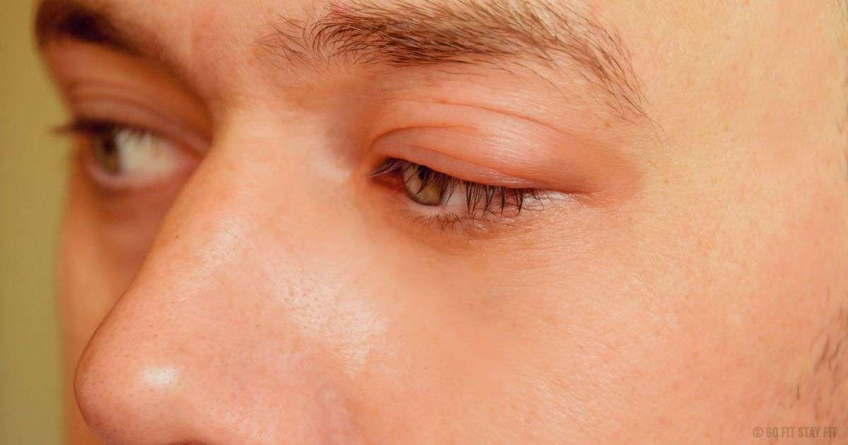 How To Get Rid Of Swollen Eyes From Allergies