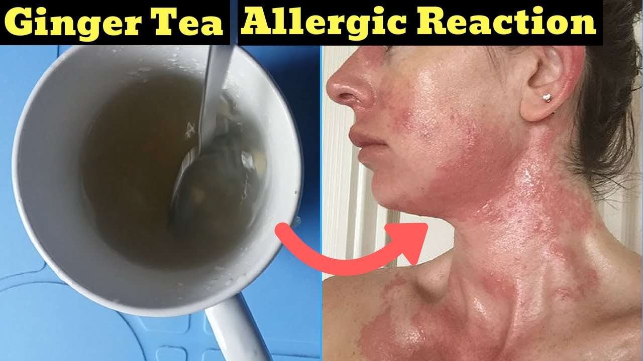 How To Make Ginger Tea For Allergic Reactions?