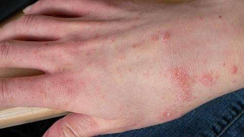 How To Take Control of your Skin Allergy &  Itching with ...