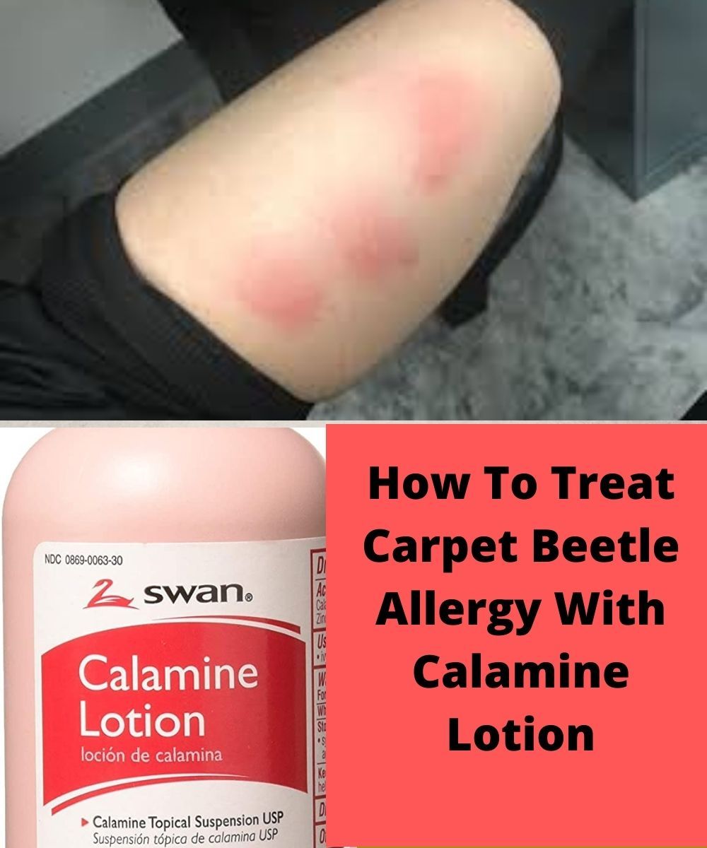 How to Treat Carpet Beetle Allergy With Calamine Lotion