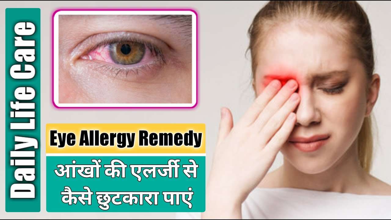 How To Treat Eye Allergy At Home