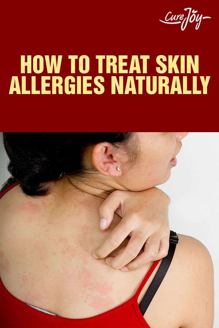 How To Treat Skin Allergies Naturally?