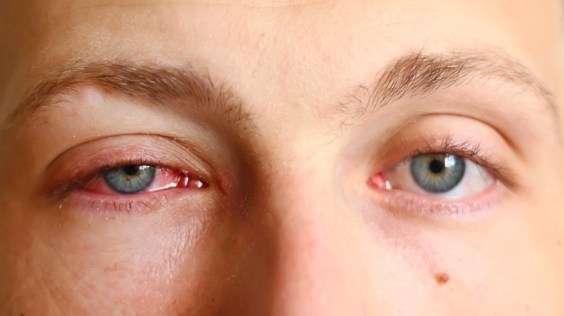 How to Treat Swollen Eyes Fast