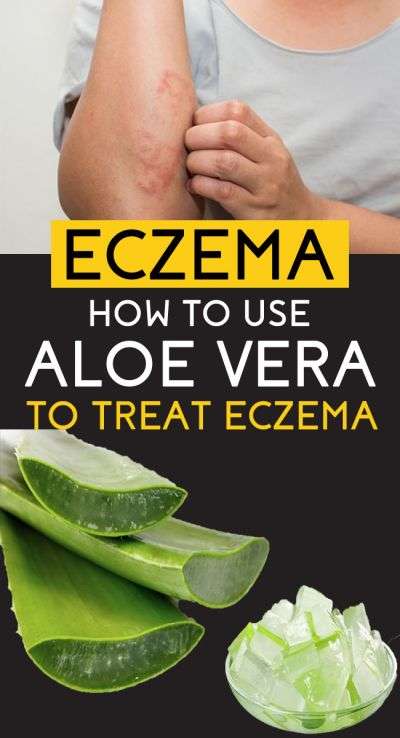 How to Use Aloe Vera for Eczema
