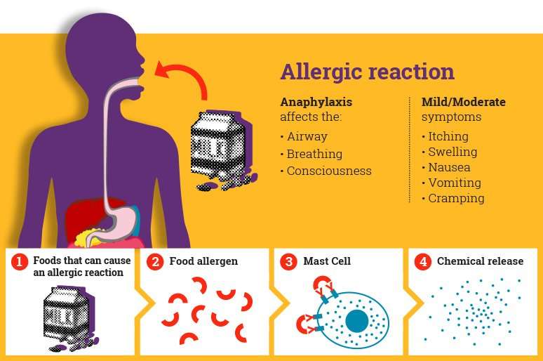 Information about Anaphylaxis for parents