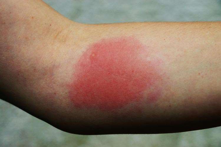 Insect sting allergy