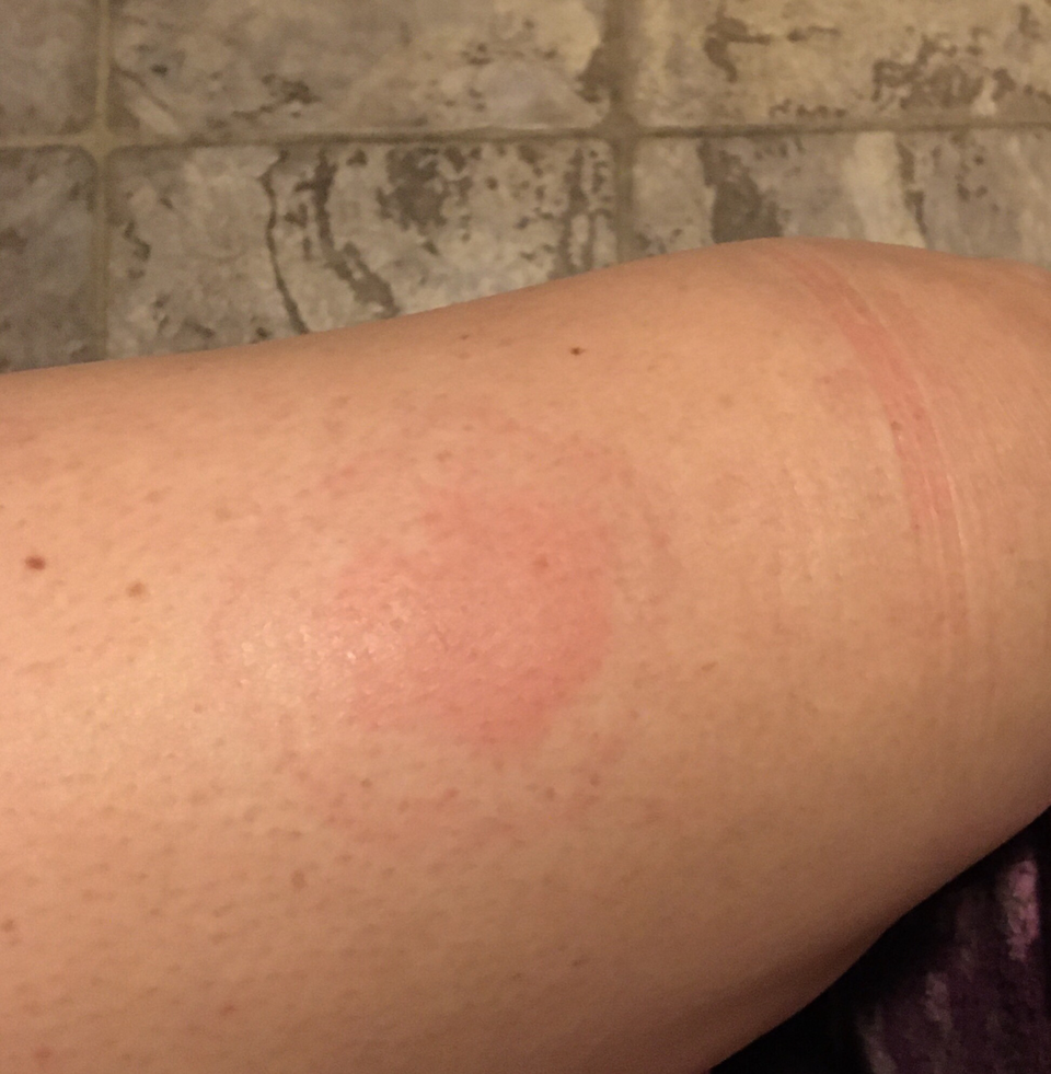 Is this an allergic reaction or site reaction? : Humira