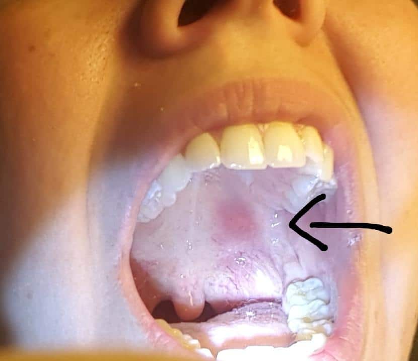 Is this just a canker sore or something else? : DiagnoseMe