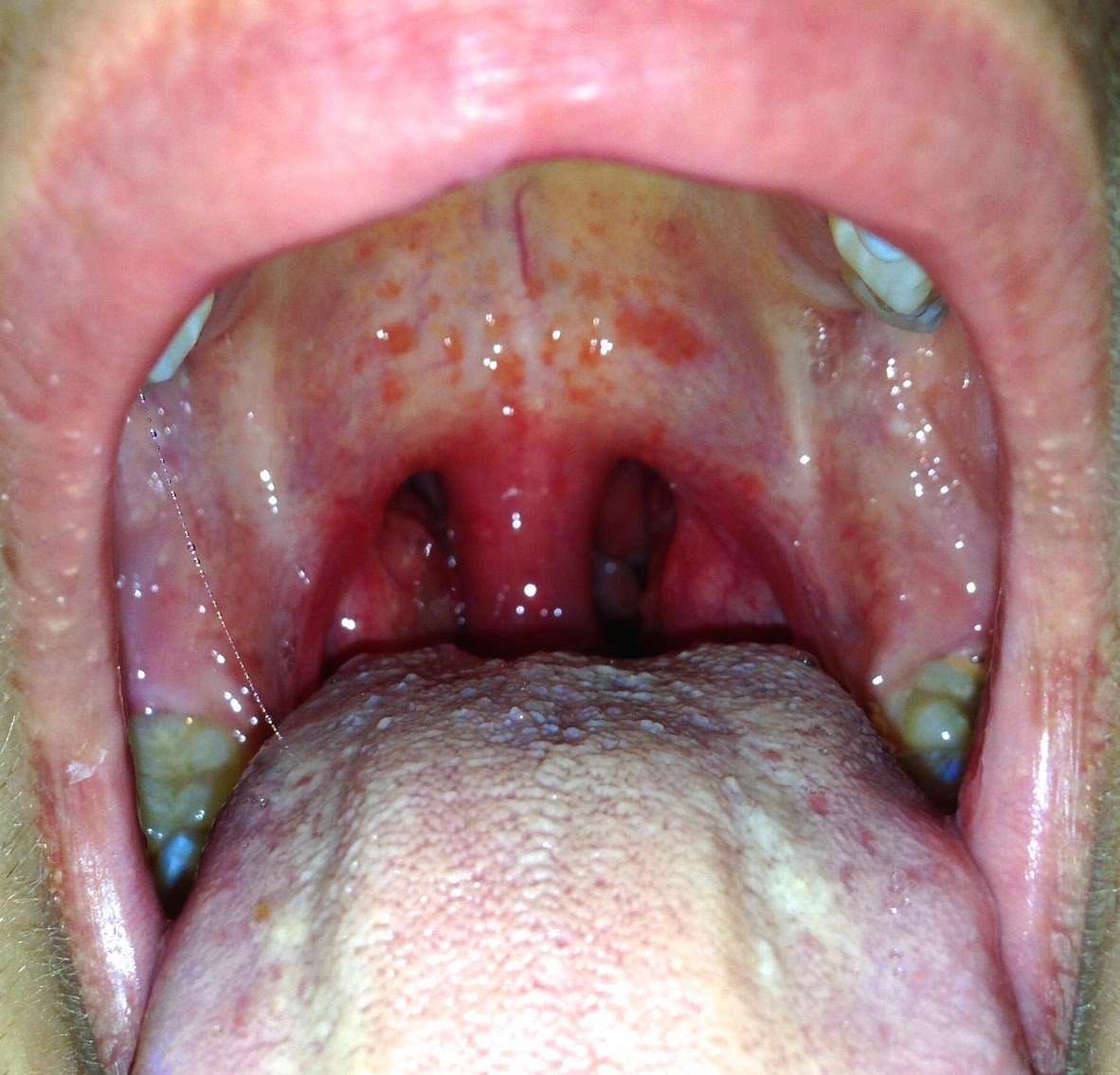 Is This Strep Throat?  Dr. Jill Grimes