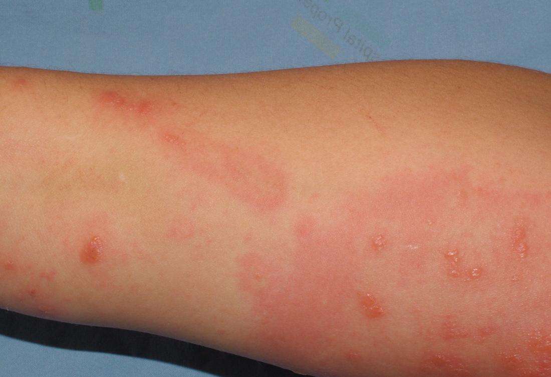 itchy rash on wrist that won t go away thaipoliceplus com