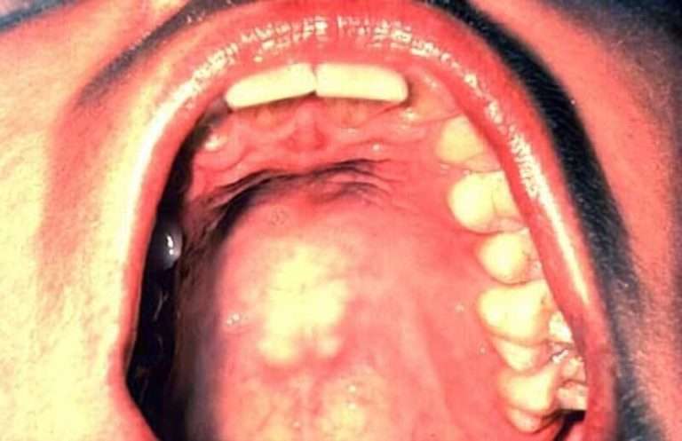 Itchy Roof of Mouth: Causes, Treatment, Remedies ...