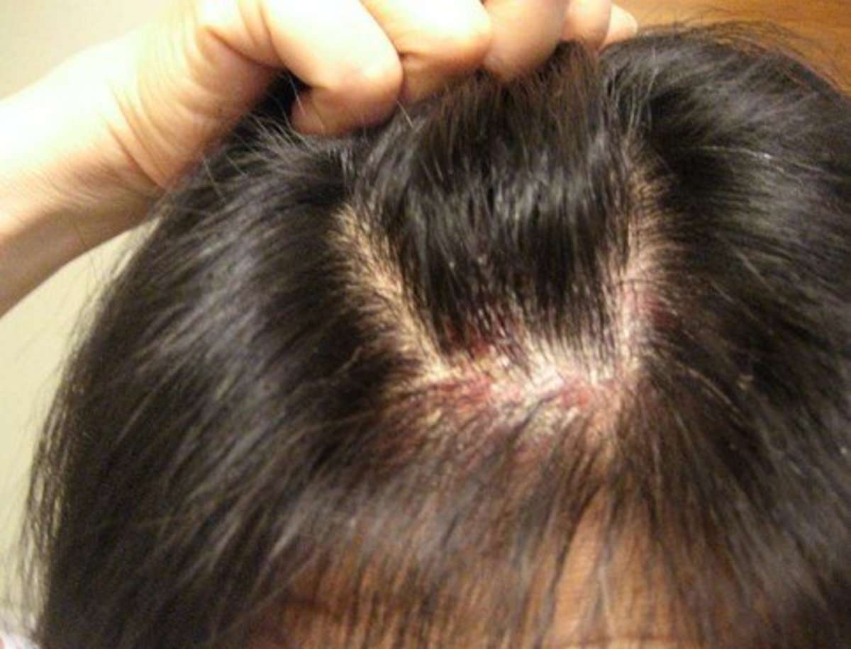 Itchy Scalp