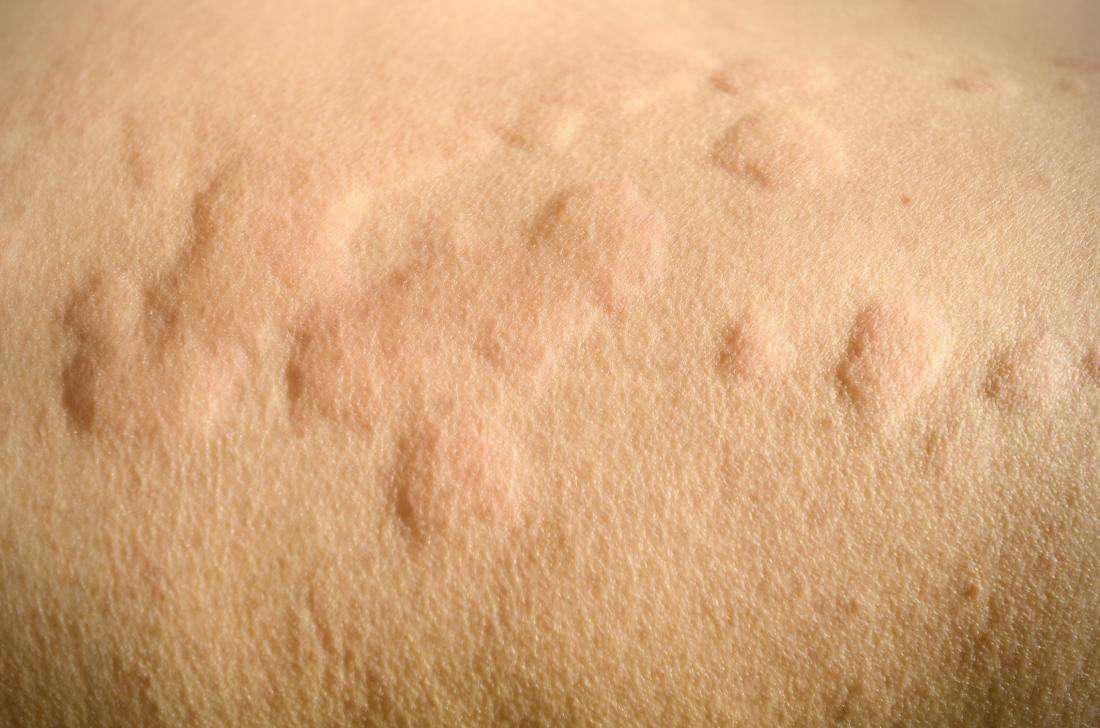 Itchy skin (pruritus): Causes, treatment, and home remedies