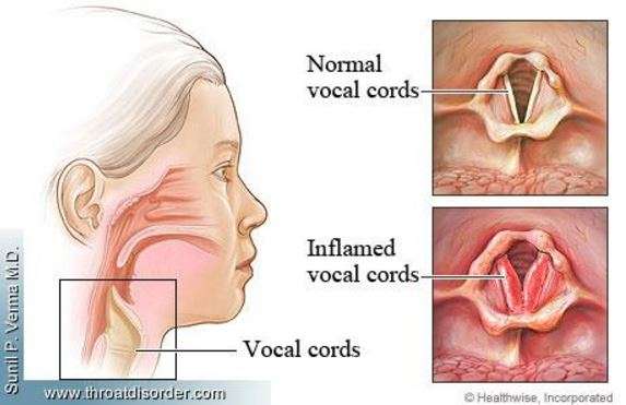 Itchy Throat Causes, Allergies, Dry Cough at Night, Get ...