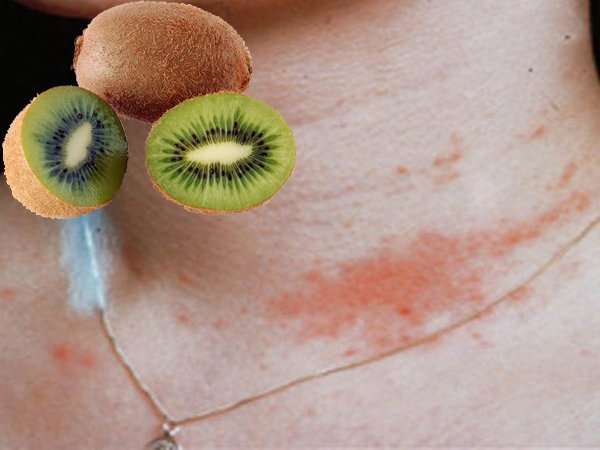Kiwi And Latex Allergy