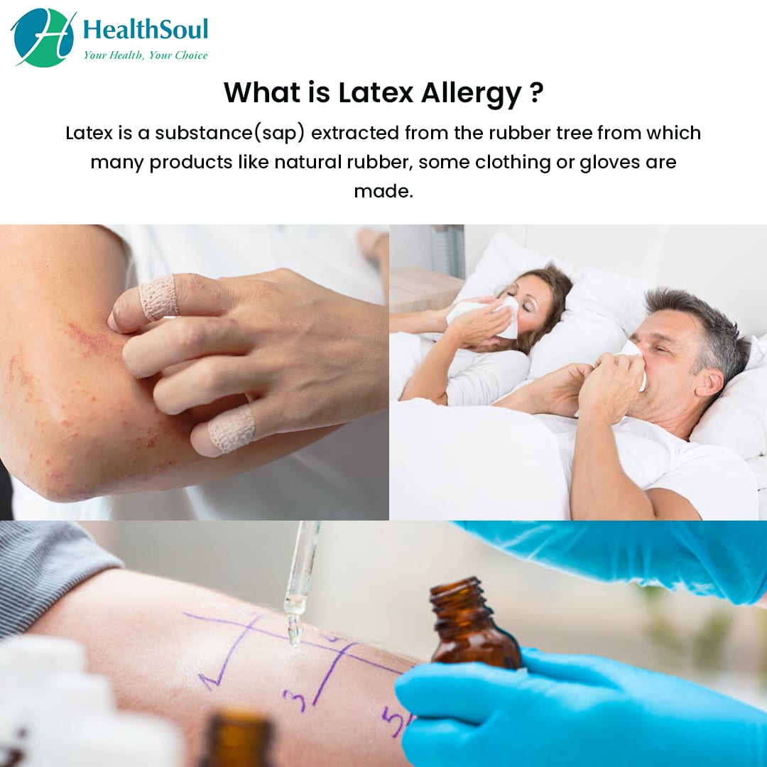 Latex Allergy: Symptoms and Management
