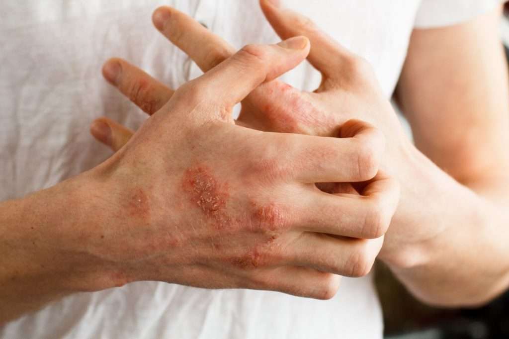 Latex Allergy: Symptoms