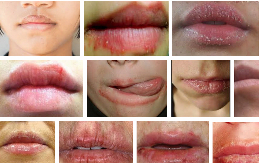 Lip dermatitis or Eczema on the lip is an inflammatory ...