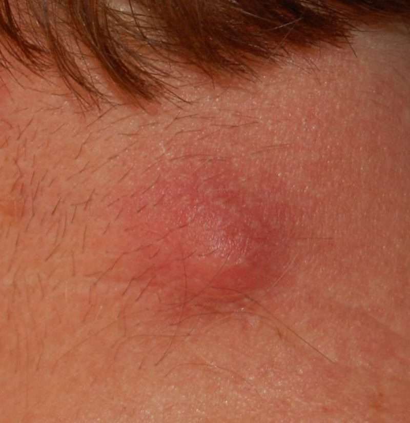 Lump on neck: Causes and pictures