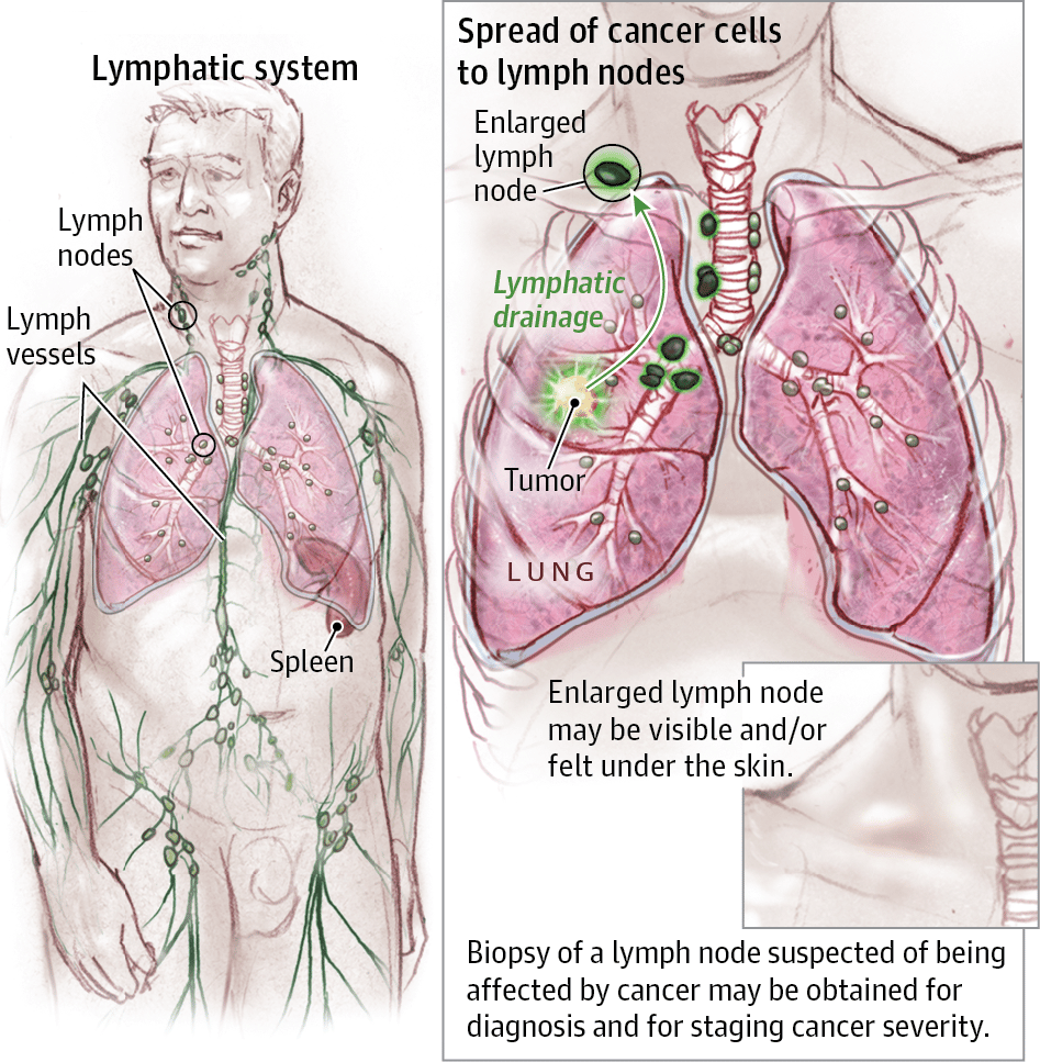 Lymph Nodes and Lymphadenopathy in Cancer