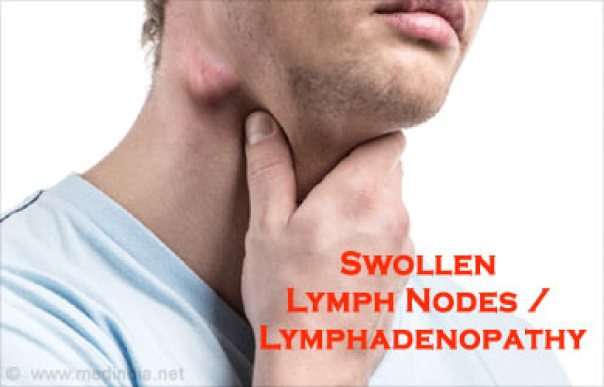 Lymphadenopathy (Enlarged Lymph Nodes) Causes, Definition ...
