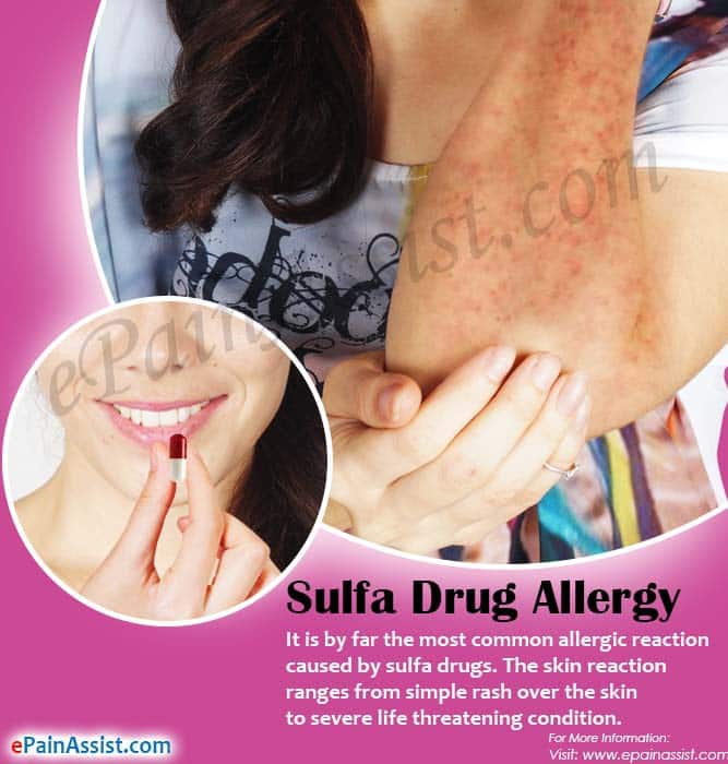 maynydesign: Celebrex And Allergy To Sulfa