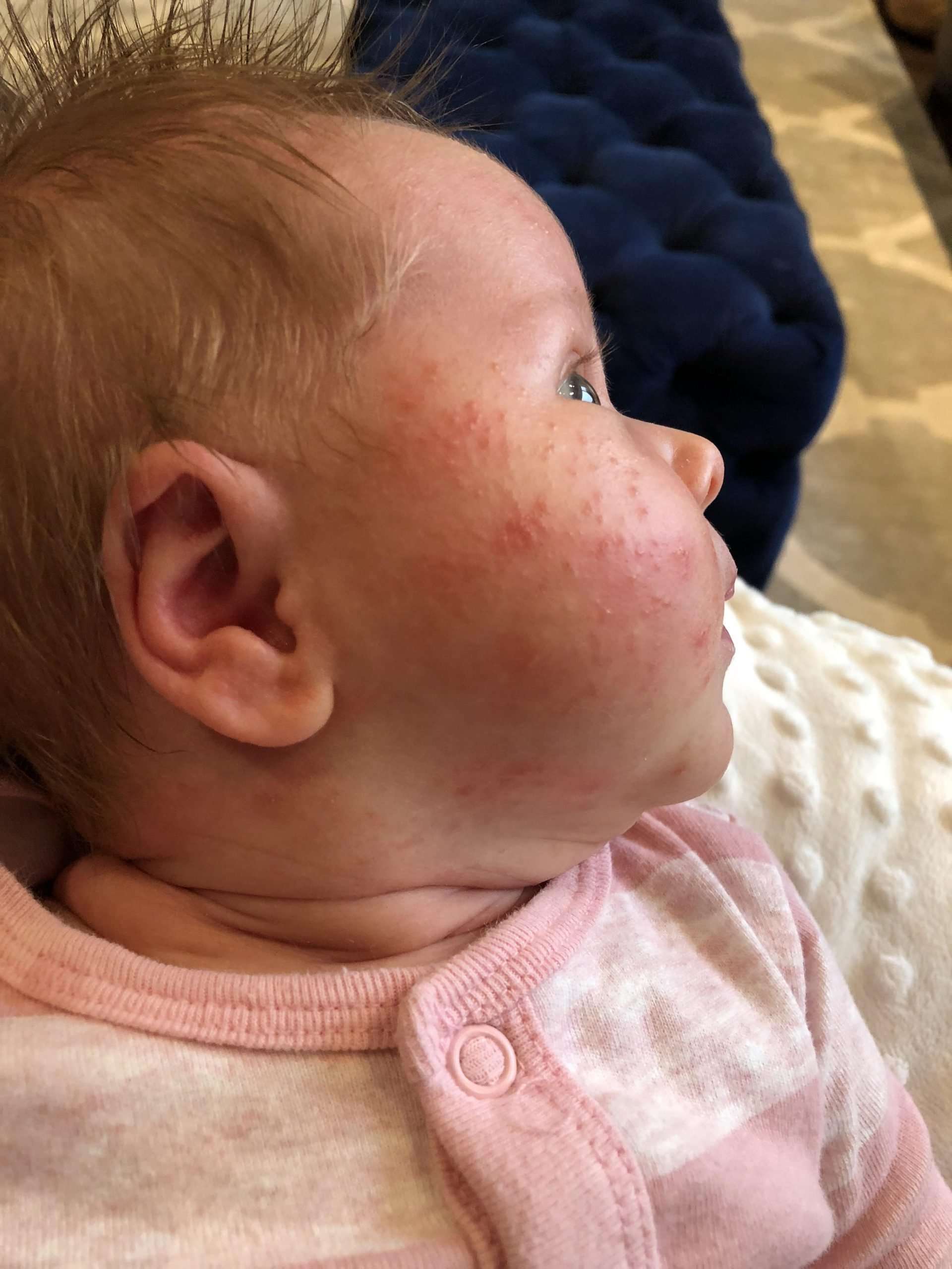 Milenium Home Tips: Babies Allergic To Breastmilk
