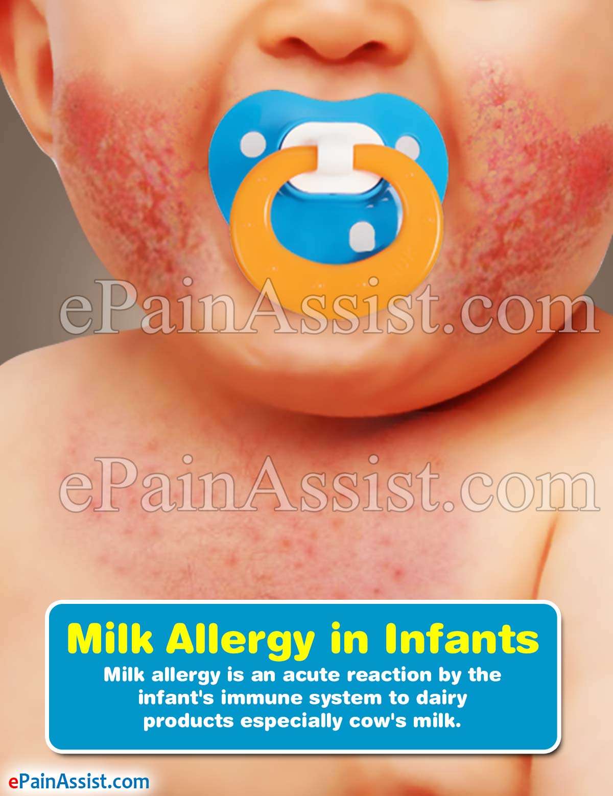 Milk Allergy in Infants