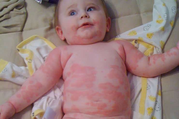 Milk Allergy Symptoms In Babies