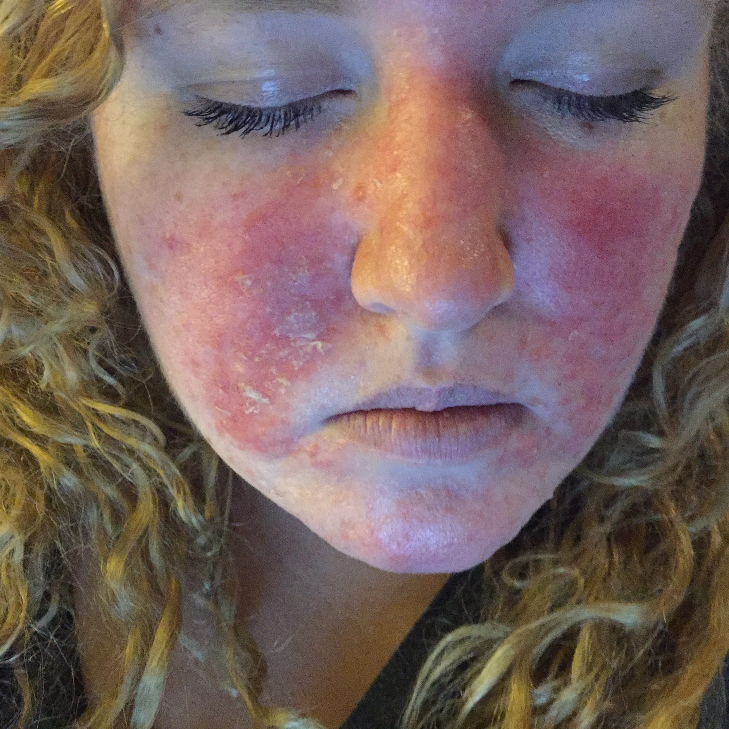 Mom Furious After Rash Caused By Popular Makeup Wipes