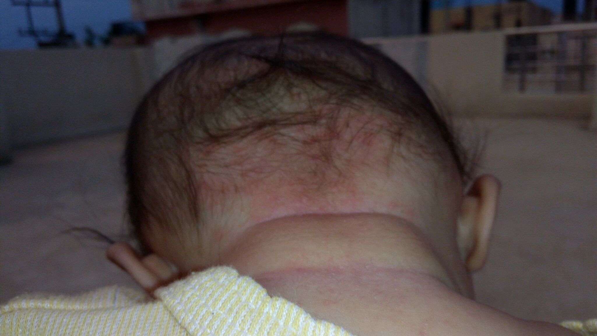 my baby got rashes on the back side of head since one week. plz suggest ...