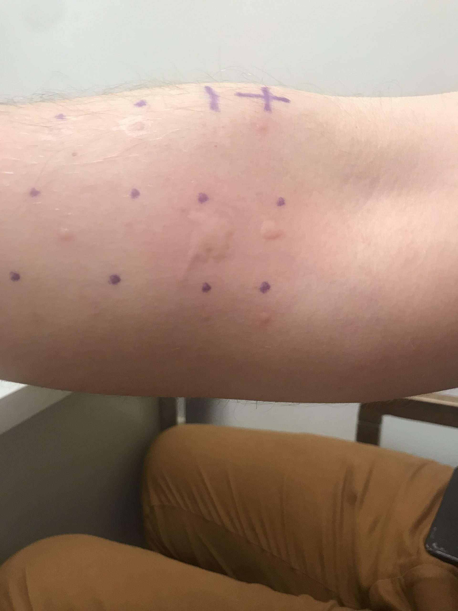 My boyfriends arm from his allergy test. He is allergic to 89% of the ...