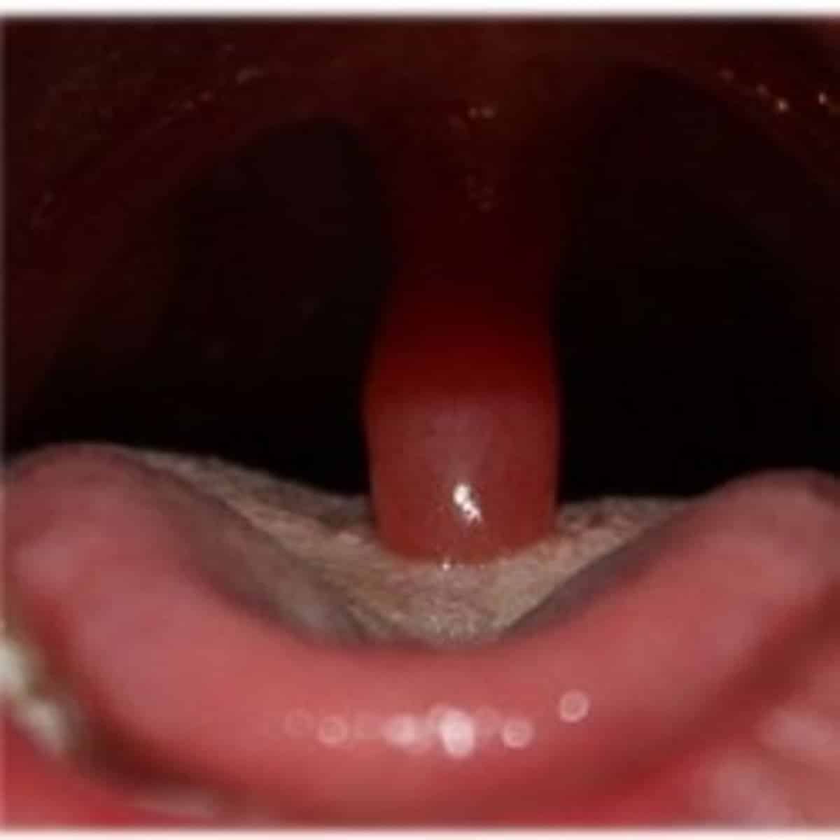 My Experience With Uvulitis (Not Fun)